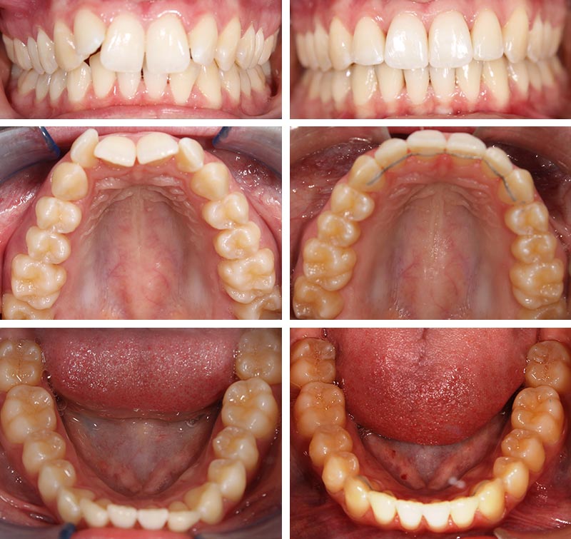 Invisalign before and after Morton Grove IL