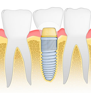 dental implants